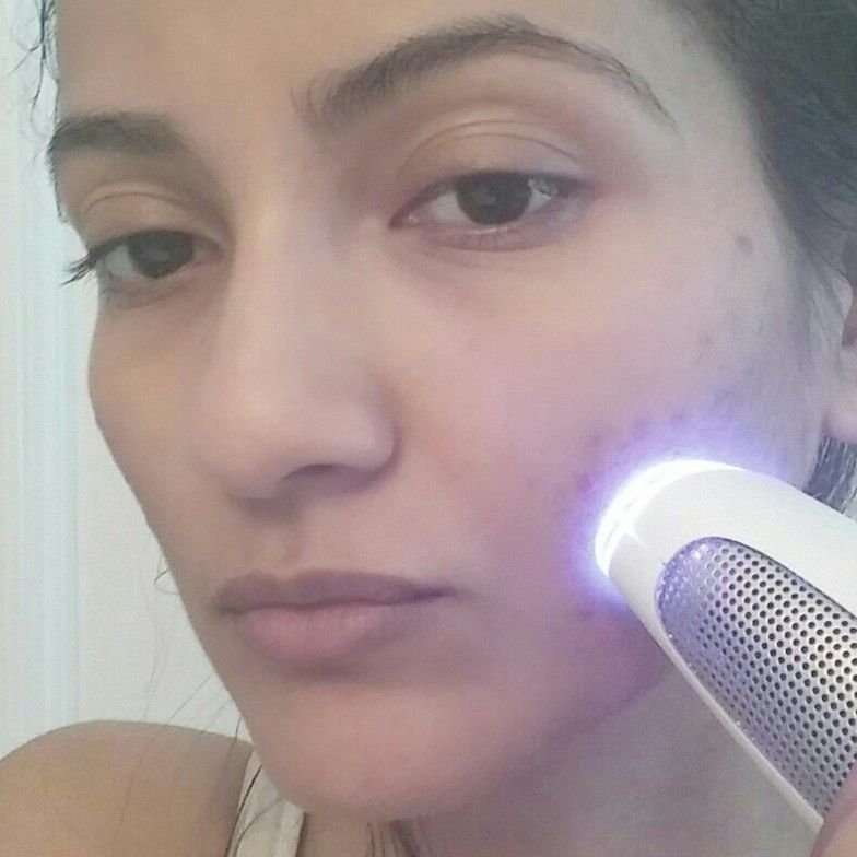 My Experience Using Blue Light on my Acne (Before & After Pics) Ella